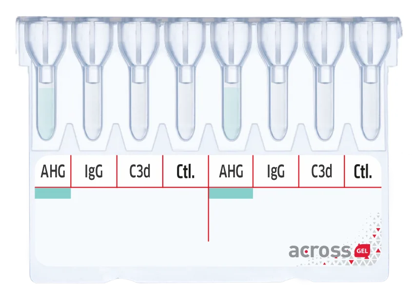 Monospecific Direct Coombs (DAT)
